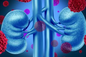 Kidney disease biomarker identified