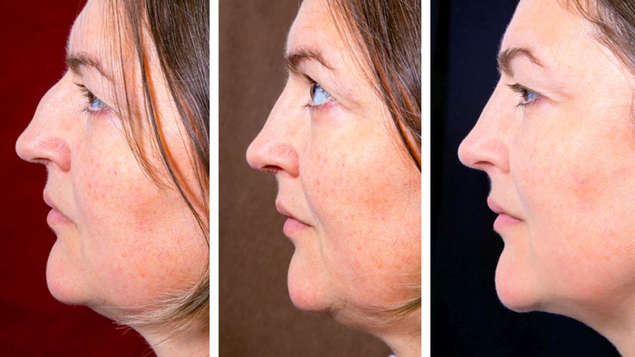 Painless and inexpensive ways to reduce double chin