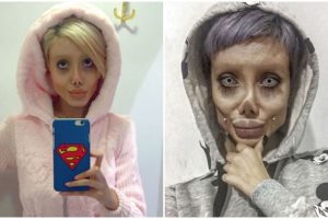 19-yr-old girl gets multiple surgeries done to look like Angelina Jolie; pics