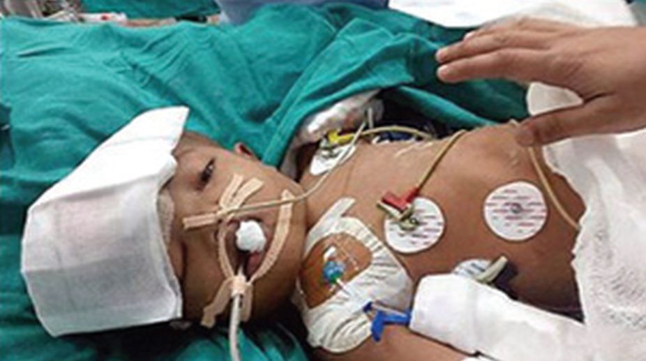 NHRC seeks Action Taken Report from AIIMS director to ensure justice for conjoined twins