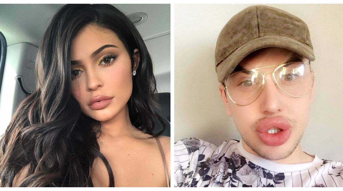 Kylie Jenner fan plays havoc with his lips in quest to get the ‘perfect pout’ | See video