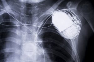 IGMC performs rare non-surgical procedure, remove broken pacemaker