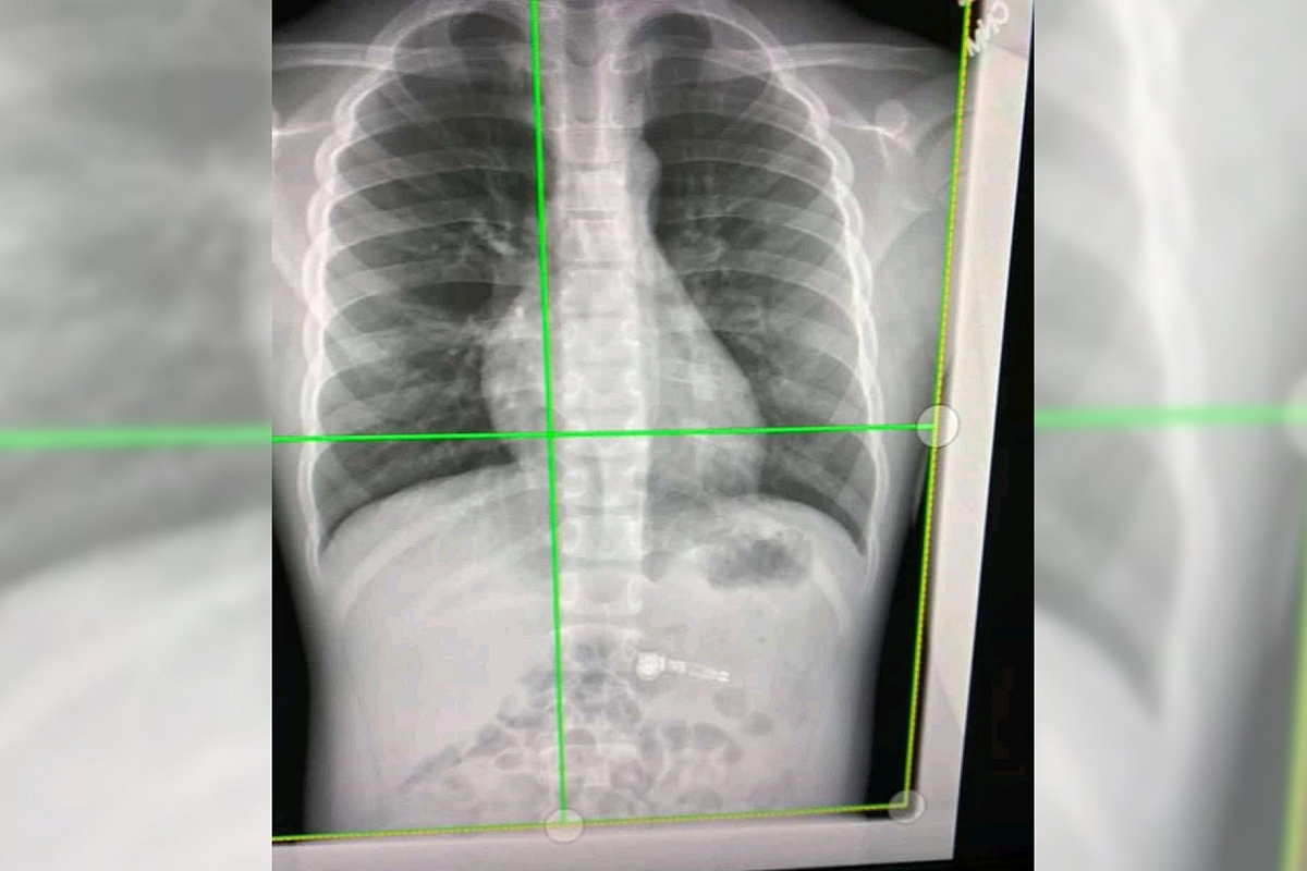 7-year-old boy got Apple Airpod as Christmas gift, he swallows one bud