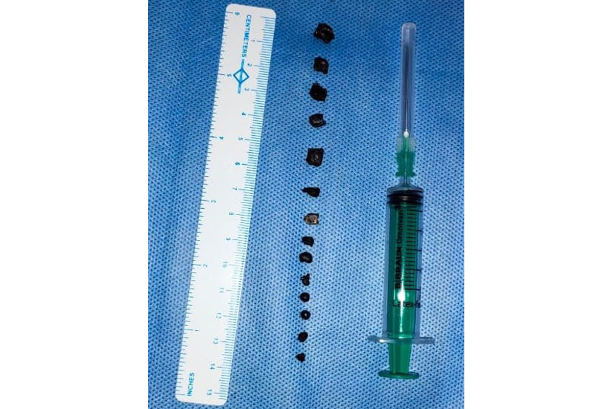 14 pellets removed from face of 12-year-old boy