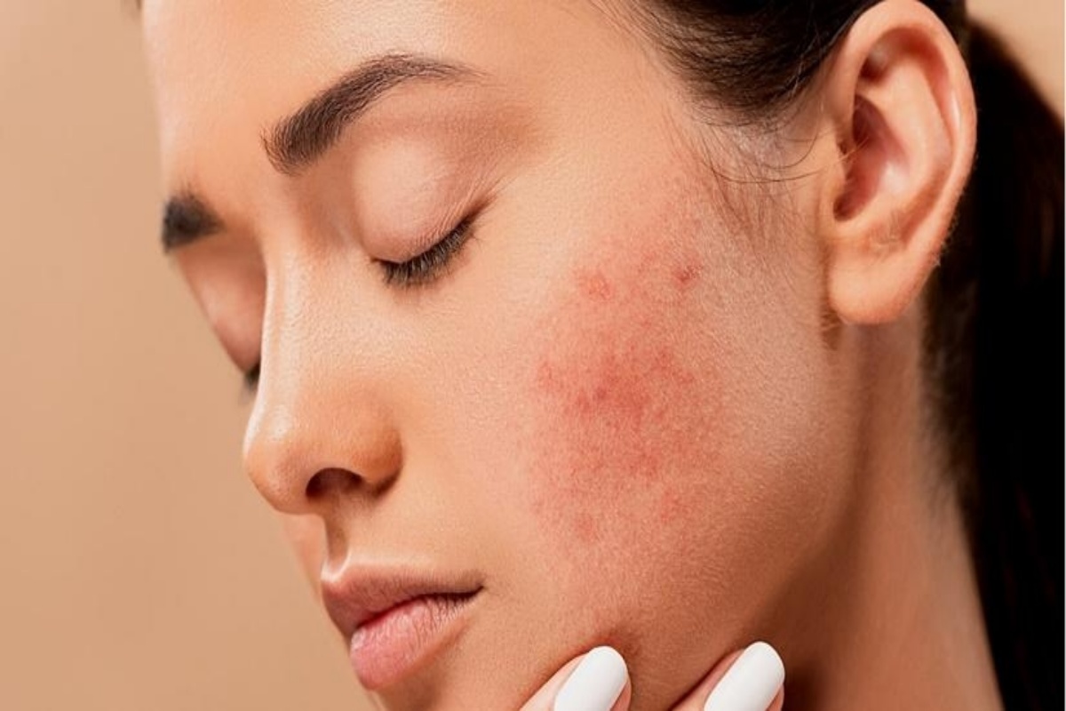 Home remedies to fight hormonal acne