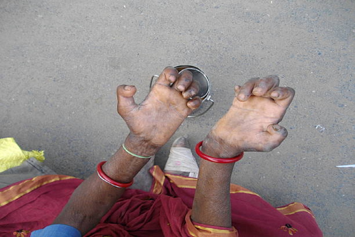 Leprosy, Odisha