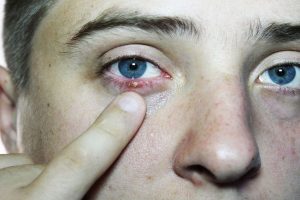 5 natural and easy remedies for eye sty