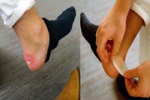 Shoo away a shoe bite with these amazing tips!