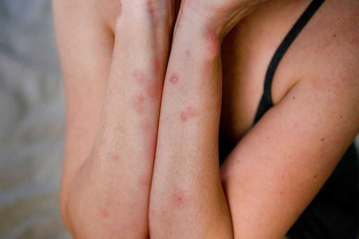 Use these ways to naturally treat bed bug bites