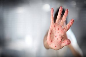 Measles outbreak kills 74 children in Afghanistan