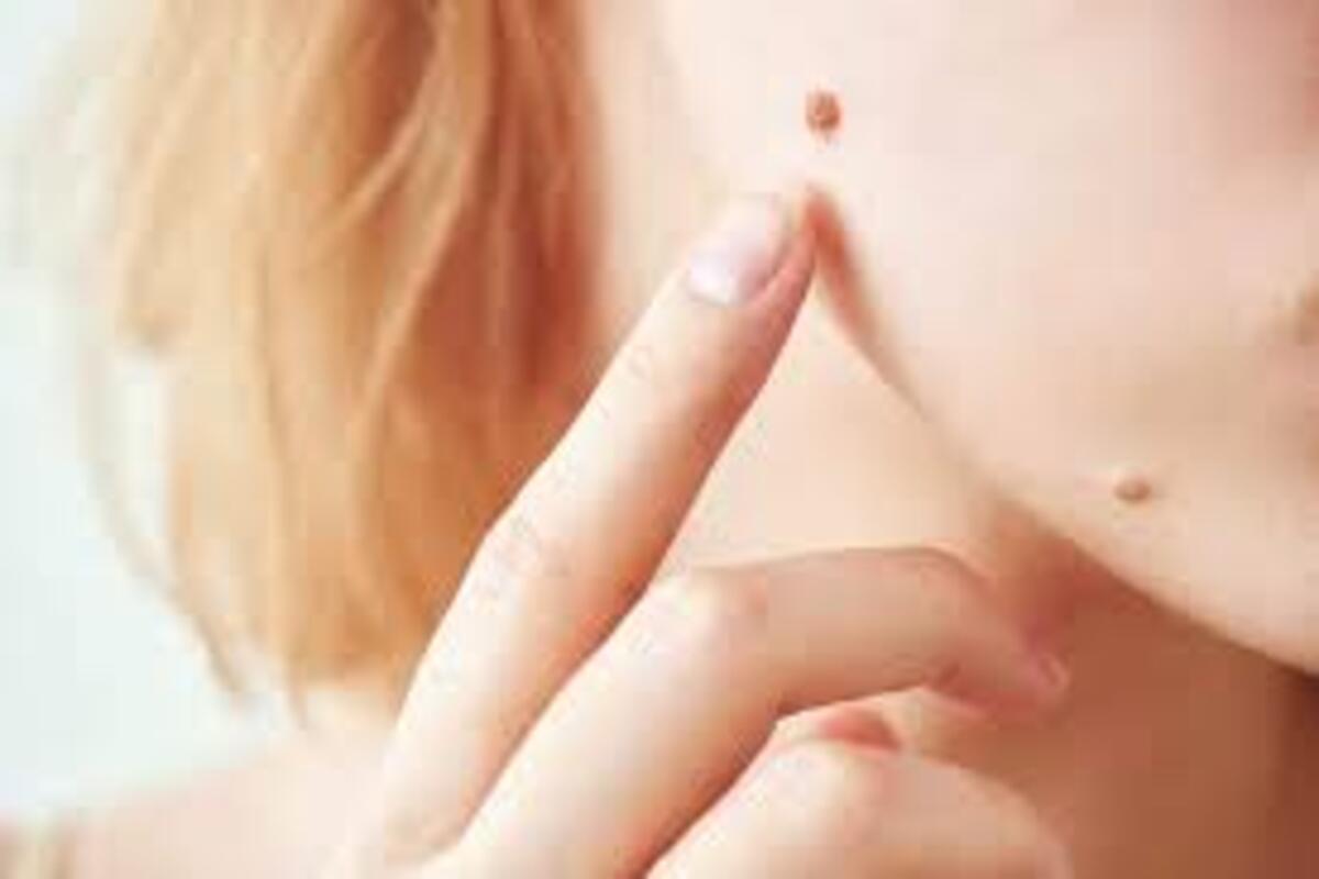 Easy home remedies to help remove moles