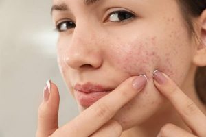Struggling with Acne? Try These Home Remedies