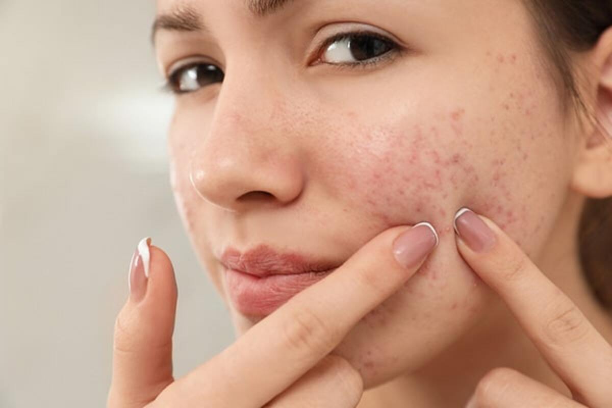 Struggling with Acne? Try These Home Remedies - The Statesman