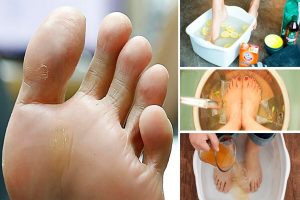 Are your feet smelling? Try these treatments to fight with it