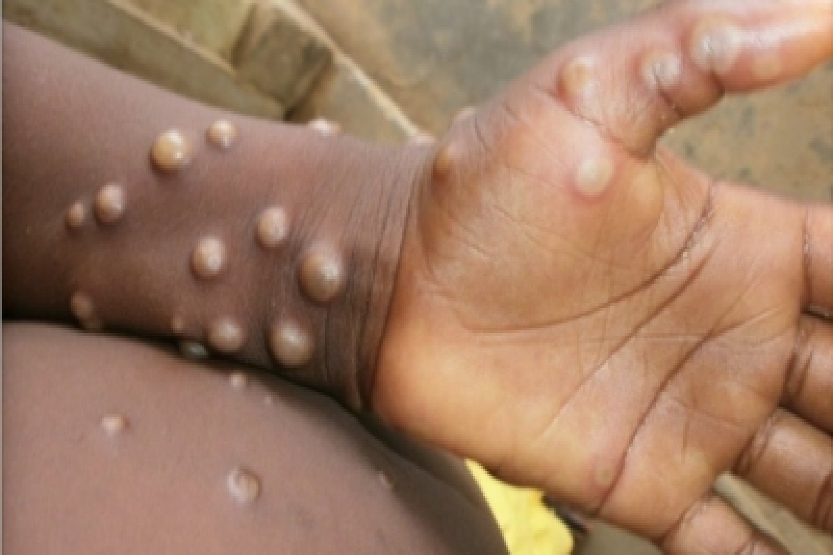 Two suspected monkeypox cases in Rajasthan