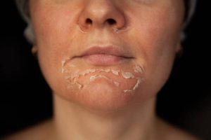 What causes flaky skin?