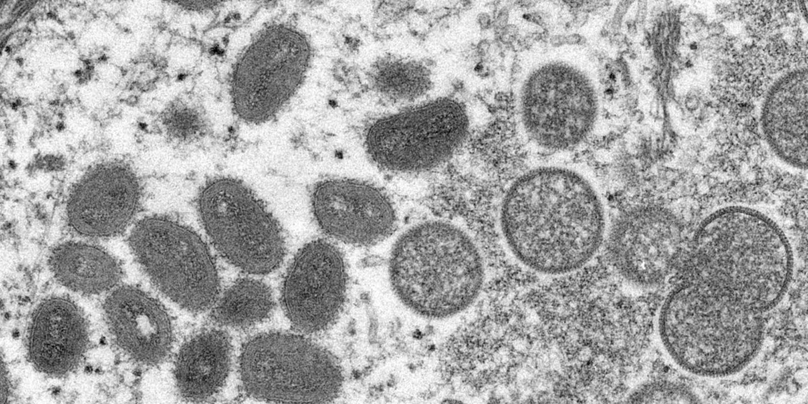 US CDC suspects monkeypox virus to be airborne, advises to wear masks