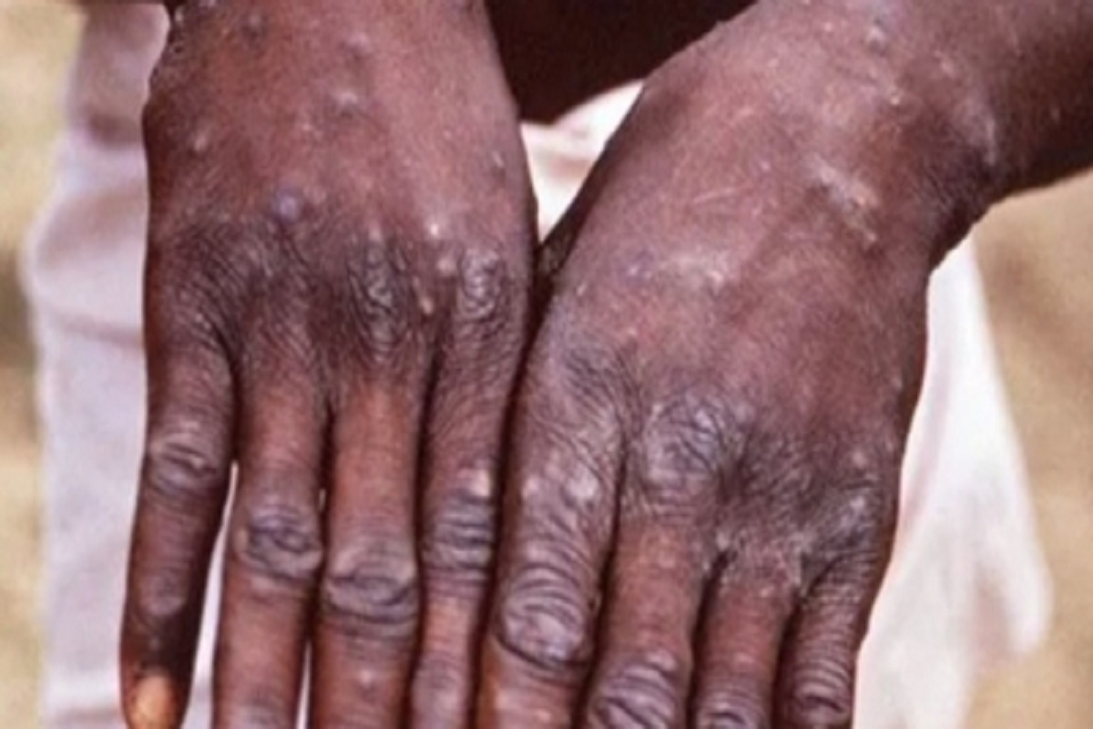 Kerala records fifth monkeypox case