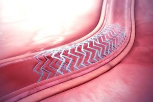 PGI Chandigarh performs first robotically assisted bioresorbable stent implantation