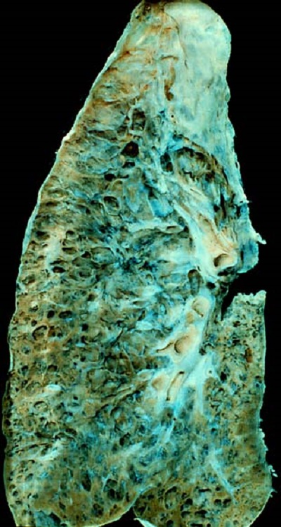 Emerging lung ailments shifting focus from tuberculosis: Experts