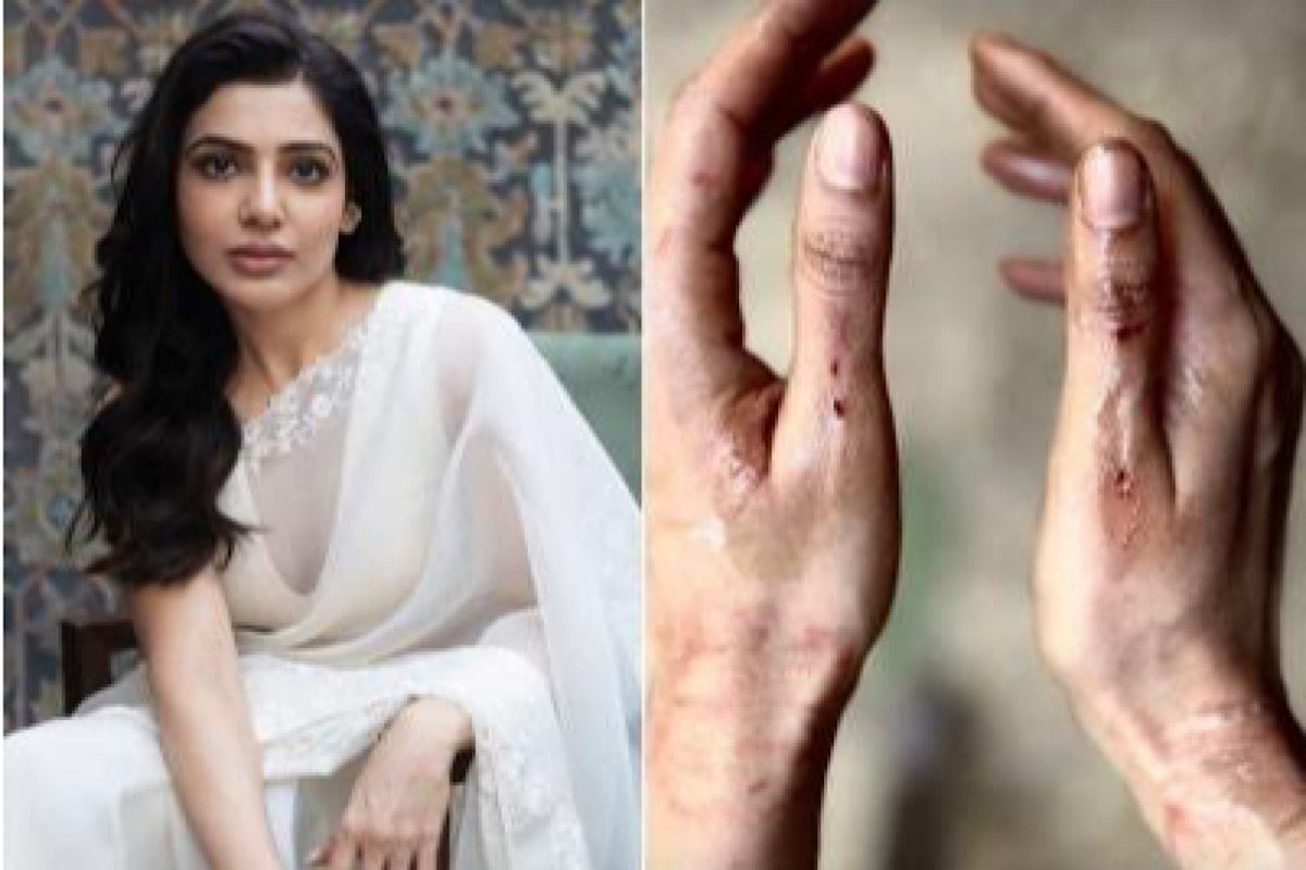 Samantha Ruth Prabhu shares pictures of bruised hands from ‘Citadel’ shoot