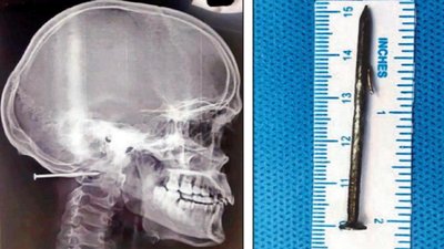 Head Saved: Nail Removed from Man’s Skull in Chennai