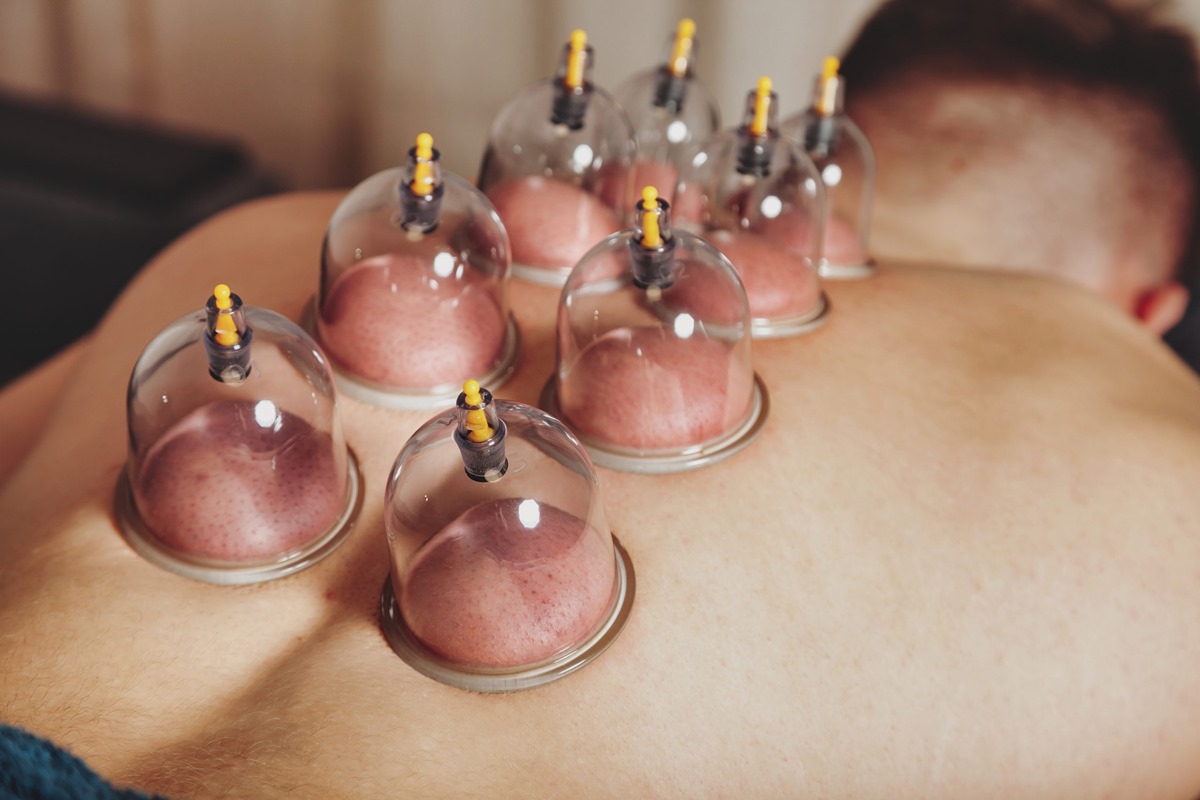 The Revival of Cupping Therapy