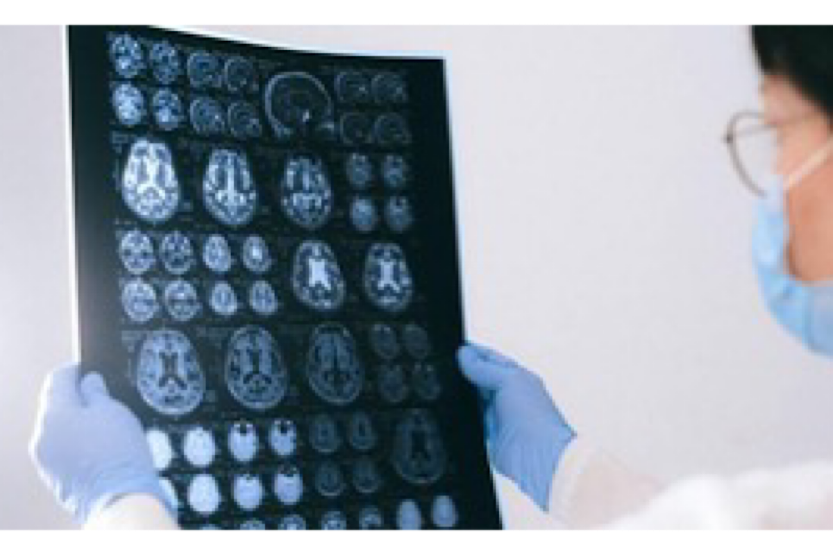 Debunking five Traumatic Brain Injury myths