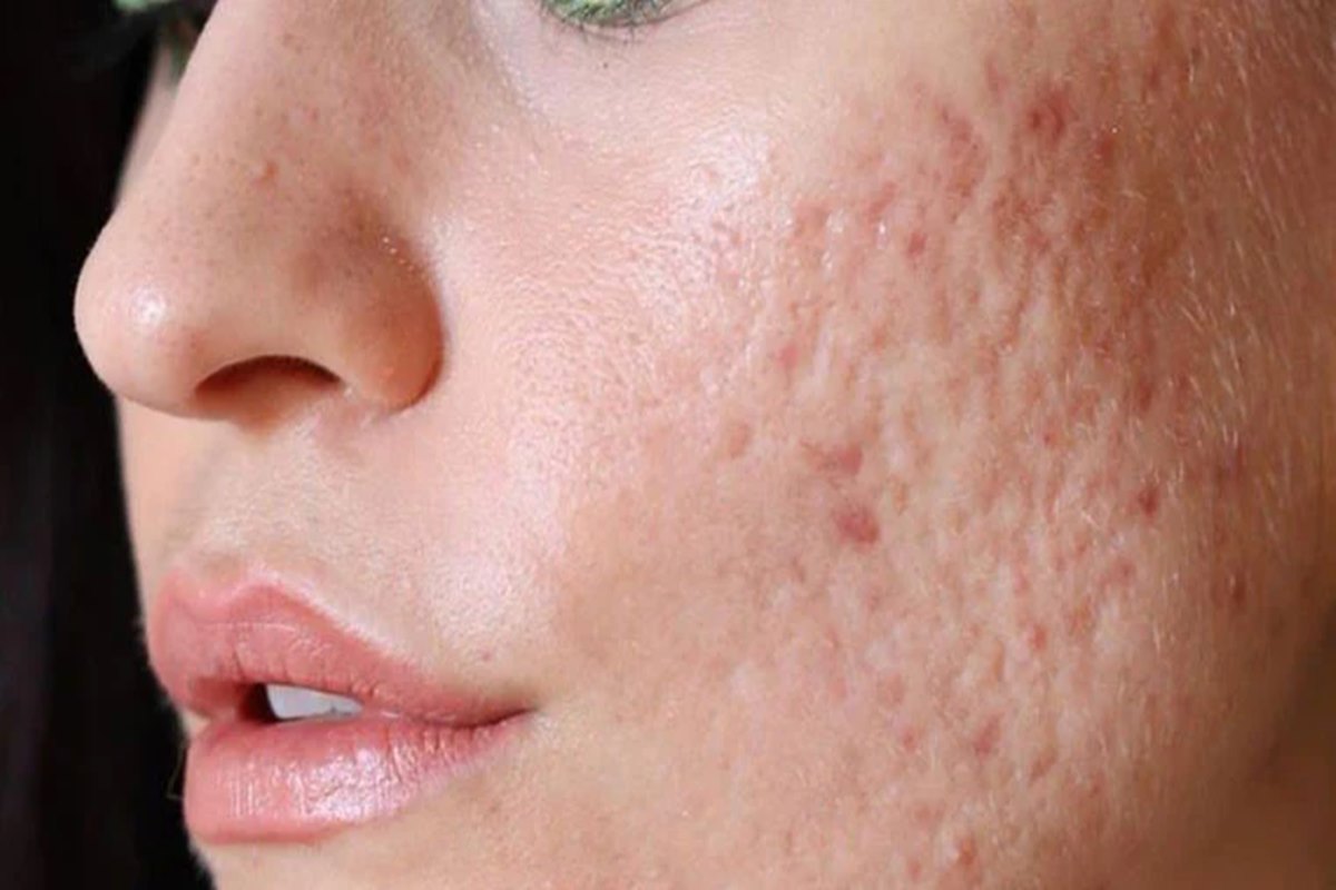 How to naturally treat acne scars