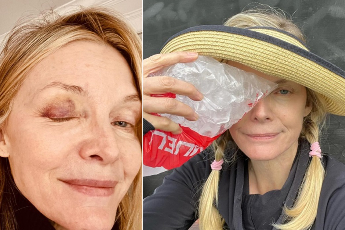 Actress Michelle Pfeiffer shows off black eye after Pickleball mishap