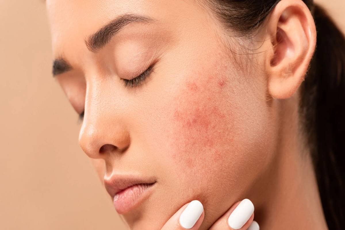 Overnight DIY solutions for banishing acne