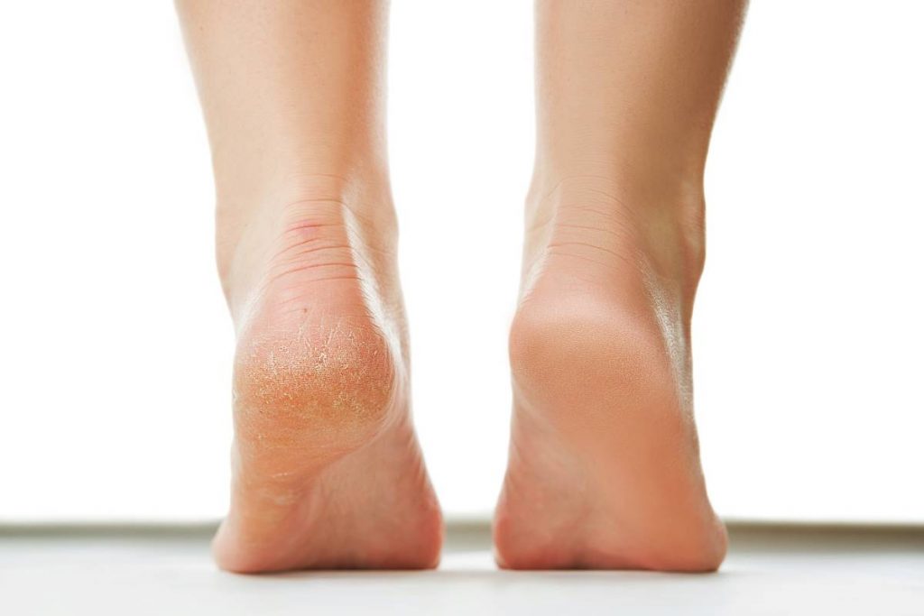 5 Ways to treat cracked heels fast | Clicks