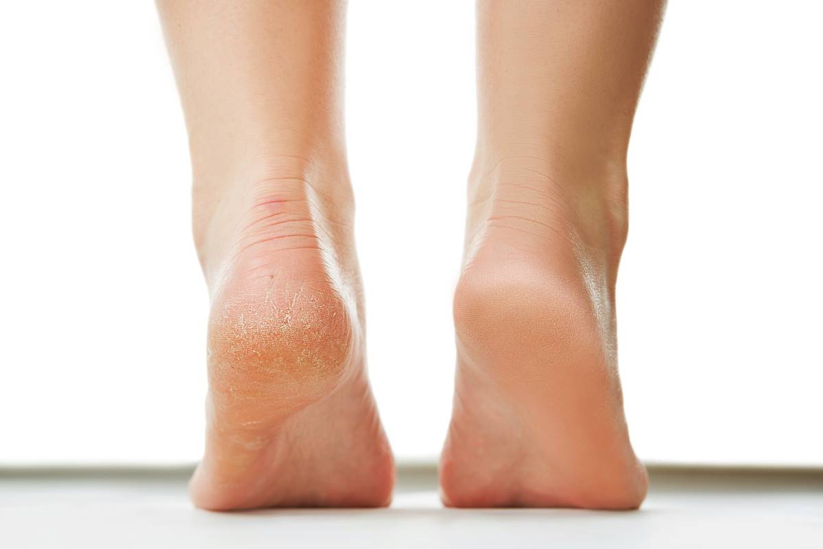Home Remedy for Cracked Heels - Saving Cent by Cent