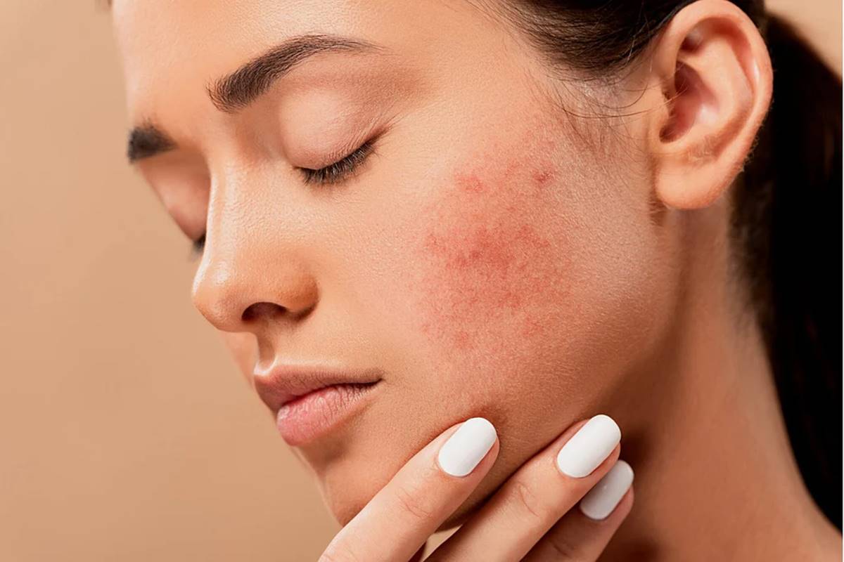 Popped your acne: How to avoid acne scars