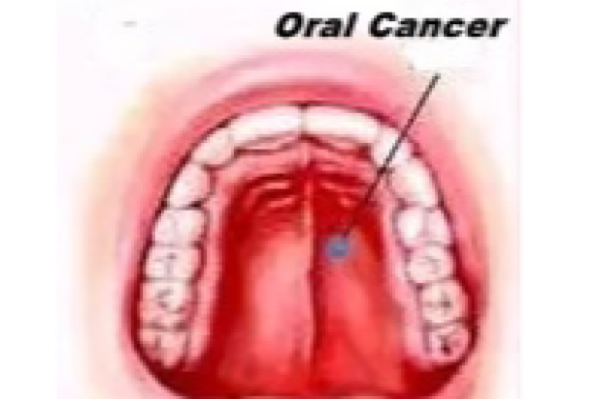 Why India is seeing a rise in oral cancer cases