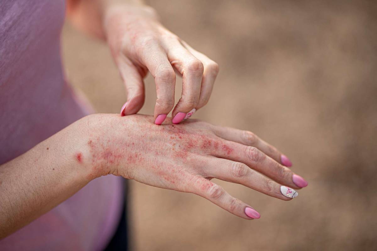 Spotlight on Patanjali’s ayurvedic remedies for treating dermatitis