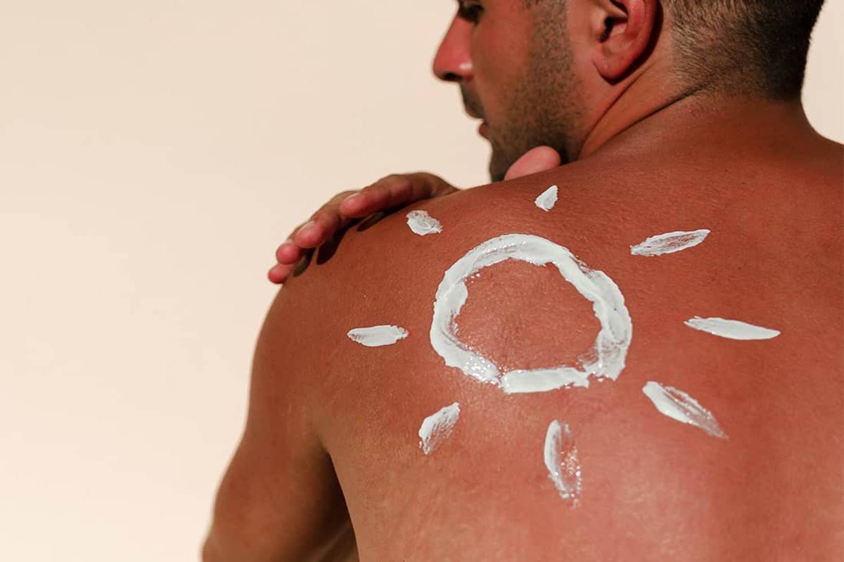 Treating sunburn with Ayurveda
