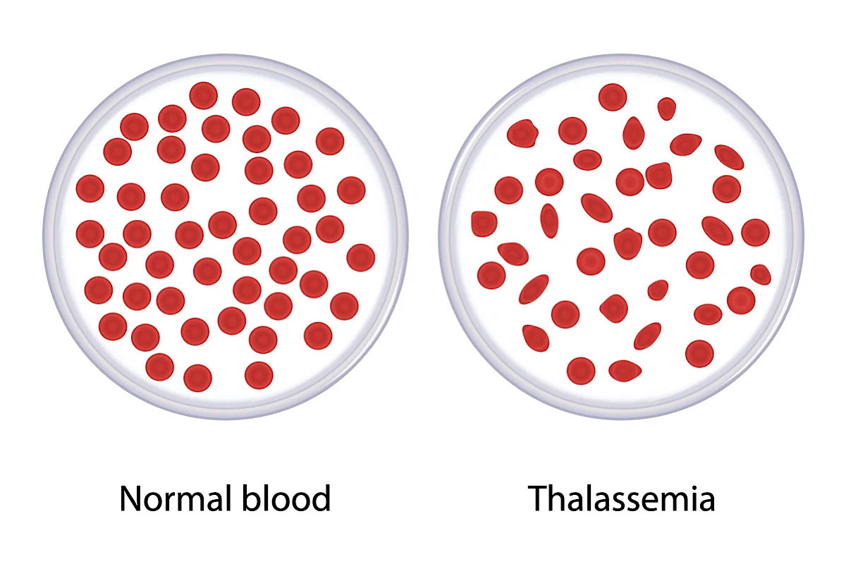 Joining hands to make a thalassemia-free world