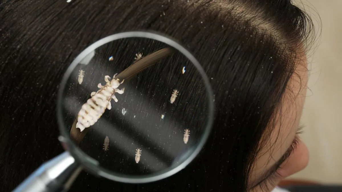 Head lice causing itching and hair problems? Acharya Balkrishna shares natural fix