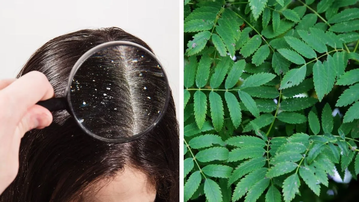 The dandruff cure you’ve been ignoring: Acharya Balkrishna’s natural neem solution that works wonders