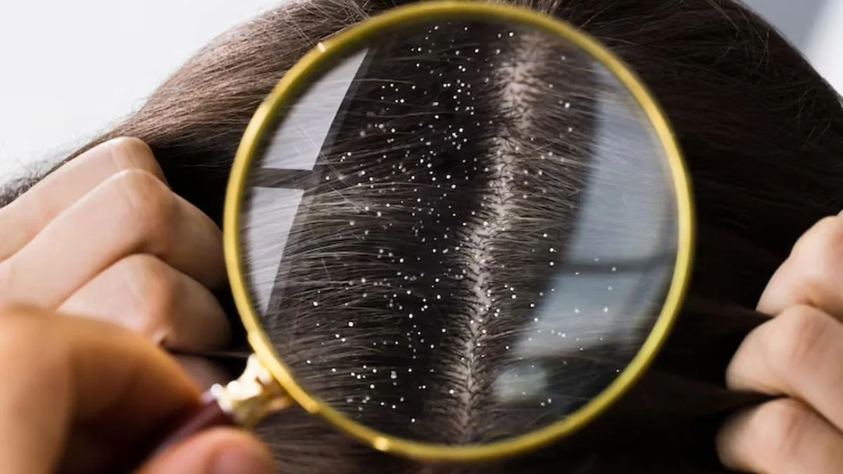 This two-ingredient kitchen fix may be the answer to your dandruff problem