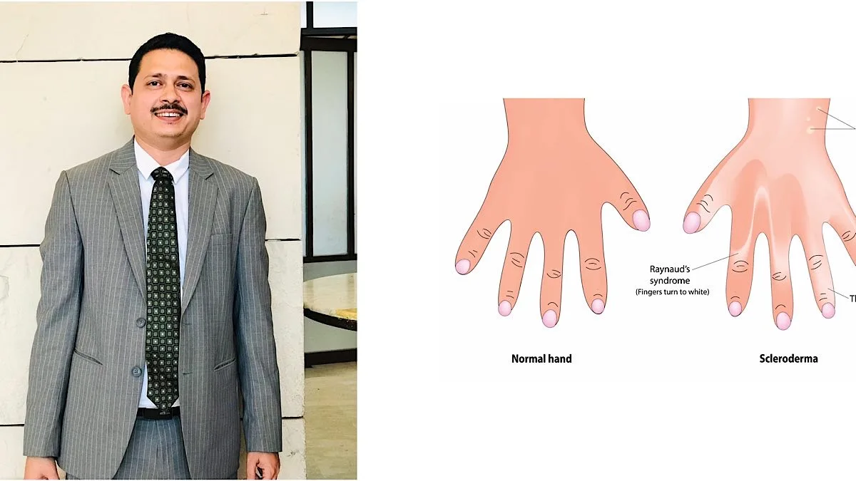 SCLERODERMA — A Mask Facies with a Million Questions