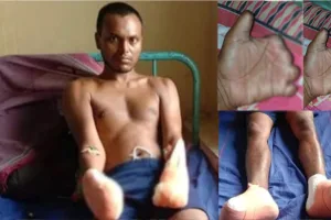 West Bengal climber lost fingers & toes to frostbite, blames TMC Raj for subpar gear; pleads BJP govt for justice