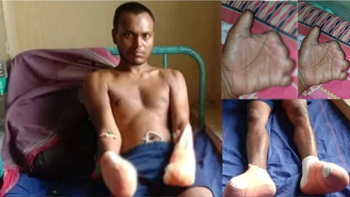 West Bengal climber lost fingers & toes to frostbite, blames TMC Raj for subpar gear; pleads BJP govt for justice