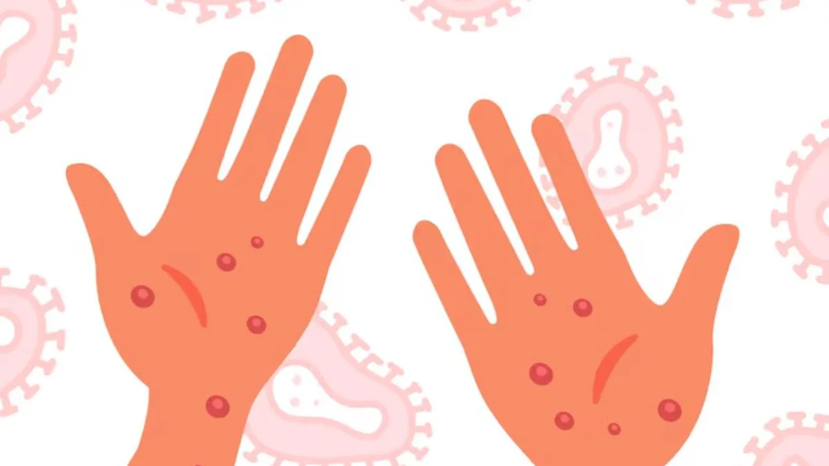 Boils and pimples troubling you? Acharya Balkrishna shares this simple ajwain paste remedy